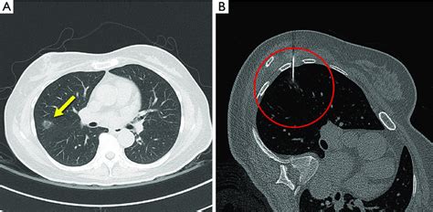 Ct Images Of Ggo Pulmonary Nodule And Ct Guided Localization Technique Hot Sex Picture