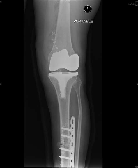 Joint Preservation And Replacement Tibia Vara Causing Oa Knee