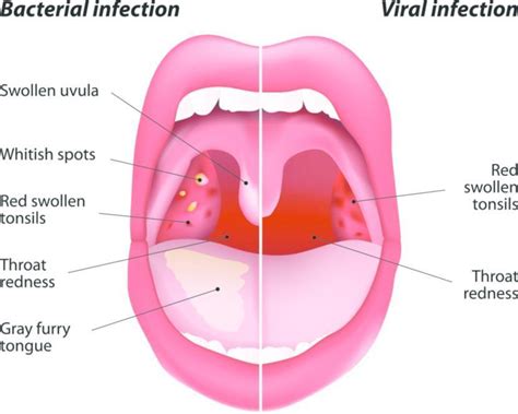 Images Of Viral Throat Infection Images Pictures Myweb
