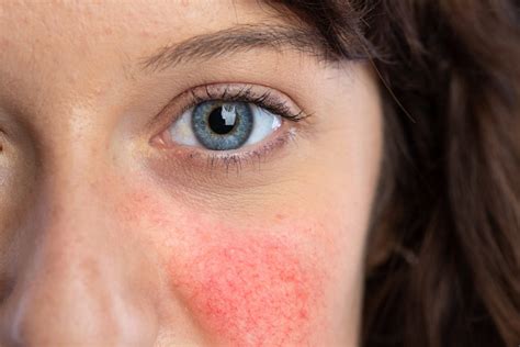 Lupus Manifestations And Traitements La Santé Au Quotidien