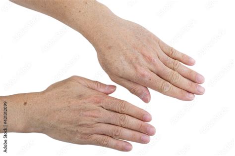 Photo Stock Small White And Brown Spots On The Skin Of Senior Man Hands