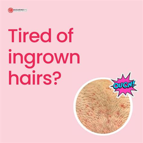 How To Treat Ingrown Hair