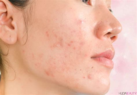 How To Finally Decode Your Acne And Find The Best Treatment For You
