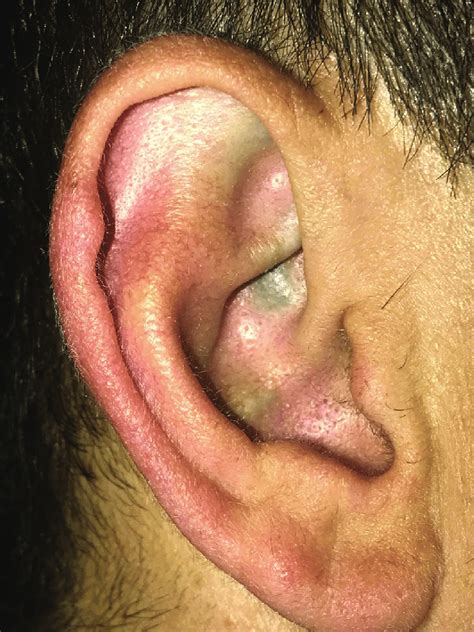 Deposit Of Dark Pigmented Tissue In External Right Ear Pigmented