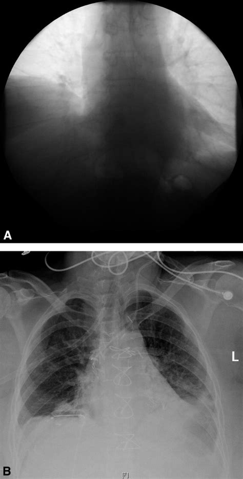 Technique Of Video Assisted Thoracoscopic Surgery Diaphragm Plication
