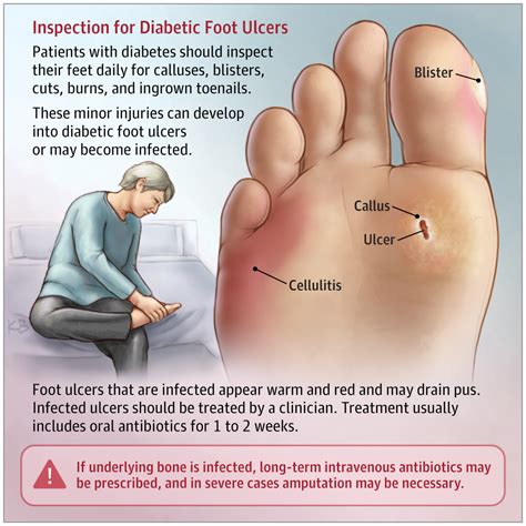Diabetic Foot Ulcers Patient Information Jama Jama Network