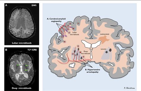 Figure 1 From Cerebral Microbleeds On Magnetic Resonance Imaging And