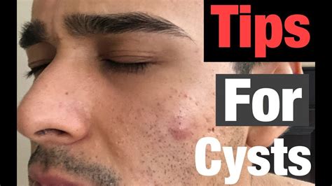 Cysts What Causes Them And How To Treat Them Youtube