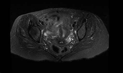 Mri Of A Female Pelvis With And Without Iv Contrast Greater Waterbury