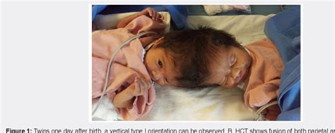 Figure 1 From A Successful Separation Of Total Vertical Craneopagus Conjoined Twins In Costa