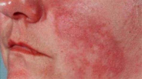 24 Get Rid Of Lupus Rash Can Even Be Part Of The
