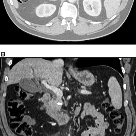 A Contrast Enhanced Axial Ct Image In The Portal Venous Phase
