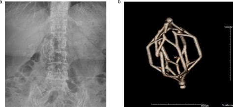 Plain Abdomen Radiograph A And The 3d Reconstructed Image B