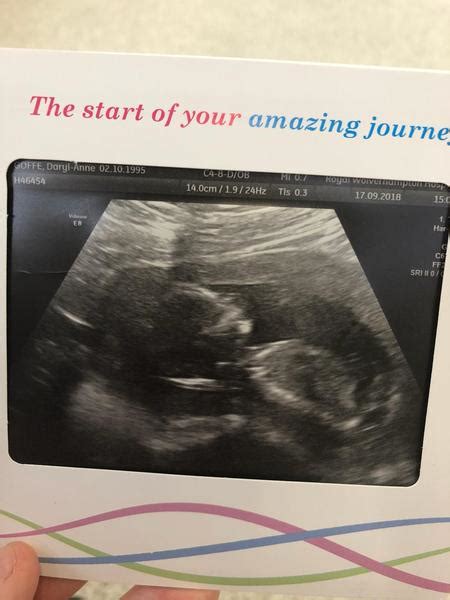 Gender Guess From 12 Week Scan Nub Theory Mumsnet