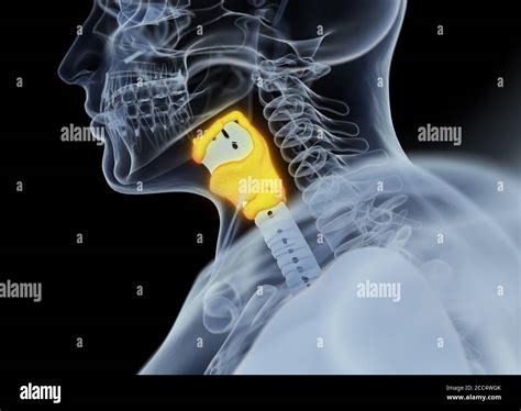 Human Larynx Tumor Fotos Und Bildmaterial In Hoher Aufl Sung Alamy