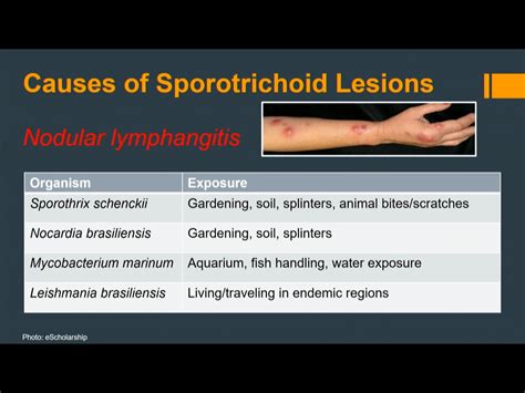 Nodular Lymphangitis Causes Of Sporotrichoid Lesions Grepmed