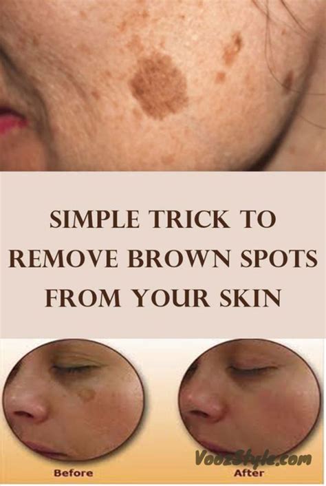 There Is Nothing Scary With Having A Few Brown Spots Also Known As Age