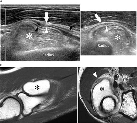 Sonographic Findings Of Parosteal Lipoma Of The Radius Causing