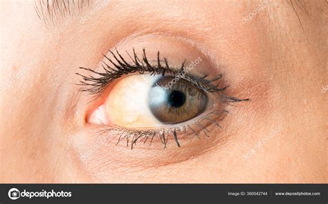 Oko Żółtaczką Która Pokazuje Zażółcenie Twardówki — Zdjęcie Stockowe