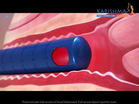 Vaginal Rejuvenation By Femtouch Laser Treatment Only Available At