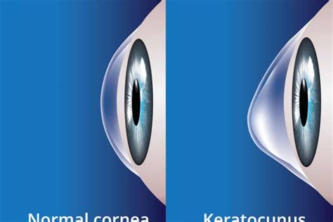 Corneal Crosslinking Can Slow The Progression Of Keratoconus In Mesa