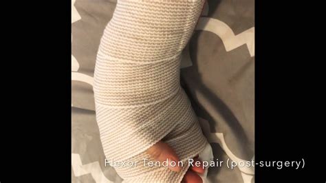 • tenolysis • acute free tendon graft • single stage flexor tendon grafting with fdp. My Flexor Tendon Repair Story - YouTube
