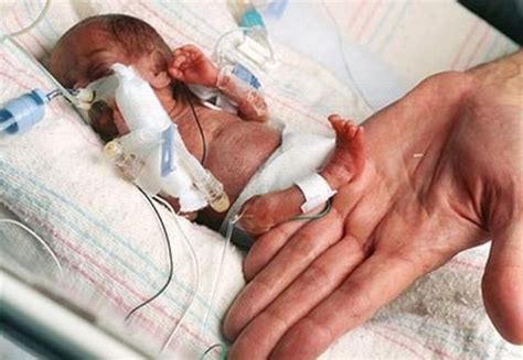 Go Ask Mum Worlds Smallest Surviving Baby Born At Just 8 Ounces Go