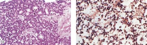 Maybe you would like to learn more about one of these? Retinoblastoma and Pseudoglioma | Ento Key