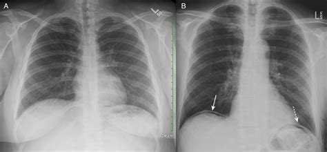 Fundamental Radiological Findings Air Beneath The Diaphragm Stepwards