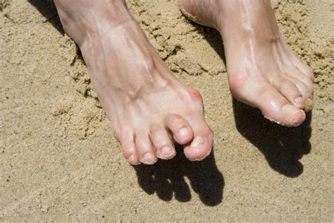What Causes Hammertoes And How Are They Treated Arizona Foot Doctors