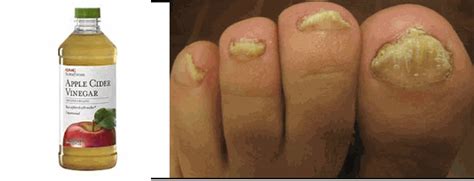 Home Remedies To Cure Toenail Fungus Listerine Foot Soak