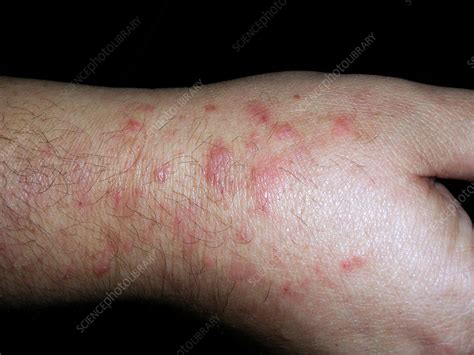 Dermatitis Herpetiformis Stock Image C0565418 Science Photo Library