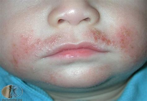 Six Of The Most Common Types Of Skin Rash Mouths Of Mums