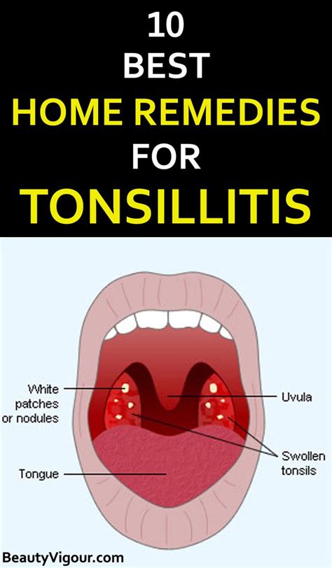 Tonsillitis Vonnie Martz