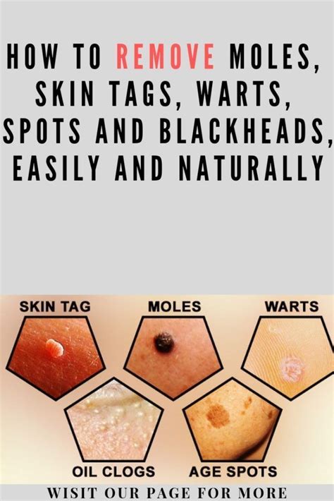 How To Remove Moles Skin Tags Warts Spots And Blackheads Easily And