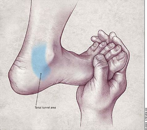 Heel pain is a common overuse injury in recreational runners. Diagnosing Heel Pain in Adults - - American Family Physician