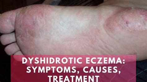Dyshidrotic Eczema Symptoms Causes And Treatment