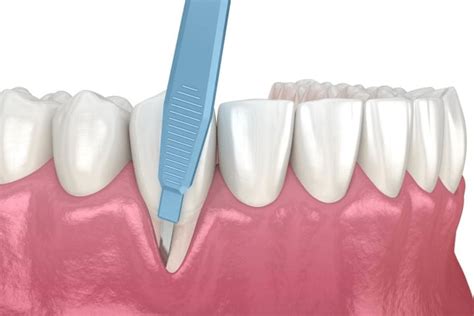 Gum Graft Procedure Periodontics Treatments