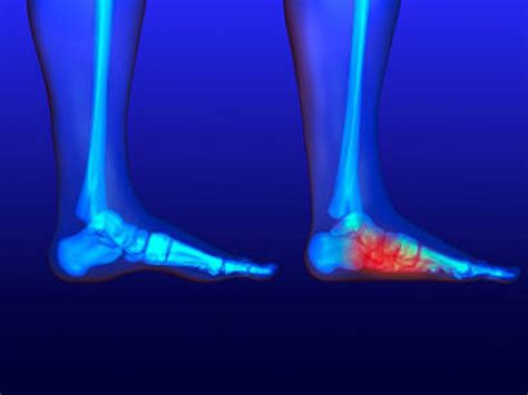 A Tell Tale Symptom Of Flat Feet