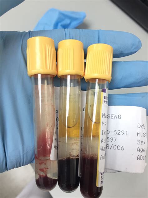 Top10 Reasons Why The Patient Blood Is Rejected From The Laboratory
