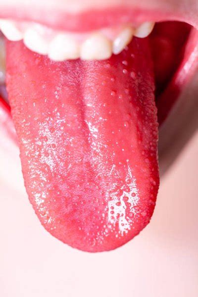 Tongue Of A Child With Scarlet Fever Strawberry Tongue — Stock Photo