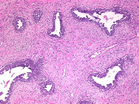 Types Fibroadenoma With Cell Changes