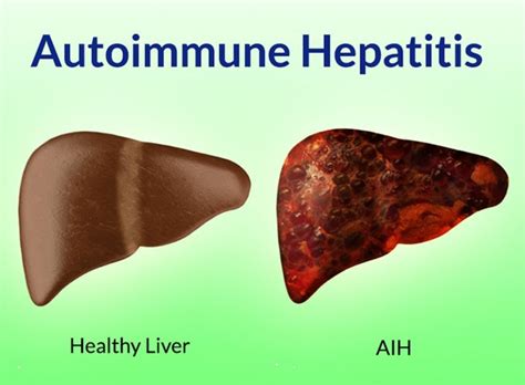Autoimmune Hepatitis And Immunosuppressive Hepatotoxicity Drugs Drug