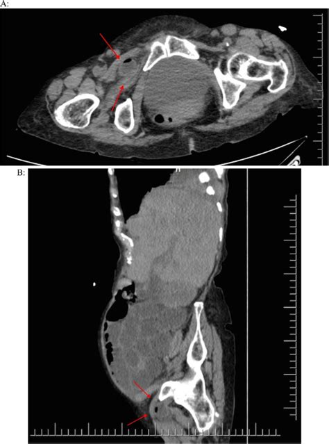 Rare Case Of Incarcerated Obturator Hernia Case Report And Review Of