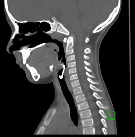 Pharyngolaryngeal Metallic Foreign Body Radiology Case Radiopaedia Org