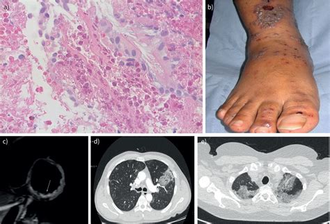 Eosinophilic Granulomatosis With Polyangiitis Case Report And