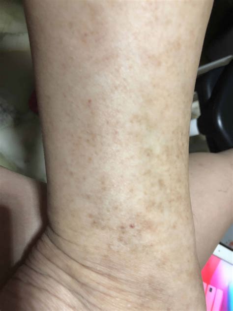 what can cause brown spots and patches appearing at my ankle and shin photo human