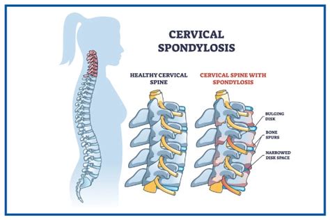 Understanding Cervical Spondylosis Causes Symptoms And Treatment