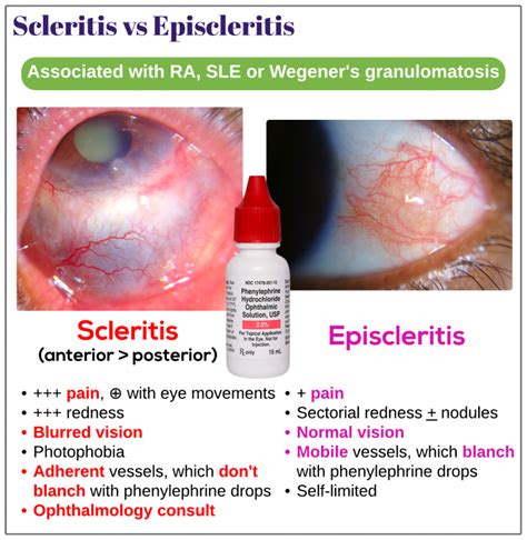 Scleritis Vs Episcleritis Medicine Keys For Mrcps