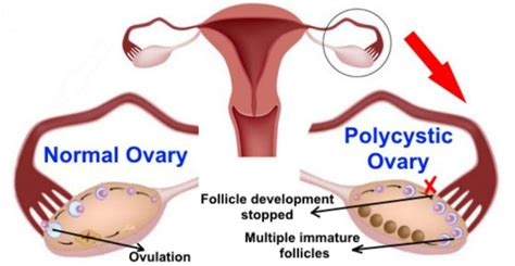 Pcos is usually defined as a clinical syndrome, not by the presence of ovarian cysts. Yoga healing for overcoming PCOS & infertility - The Yoga ...